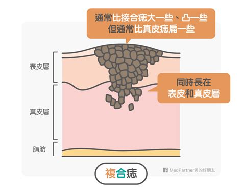 點痣改運ptt|[心得] 點痣怎麼做？點痣筆有效嗎？點痣全攻略